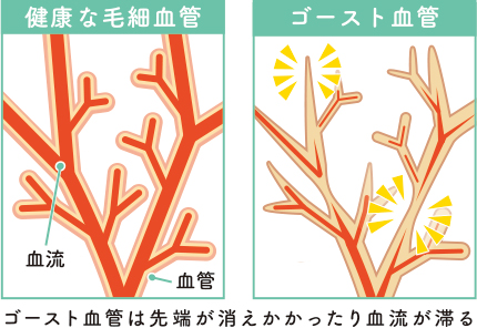 ゴースト血管としわ