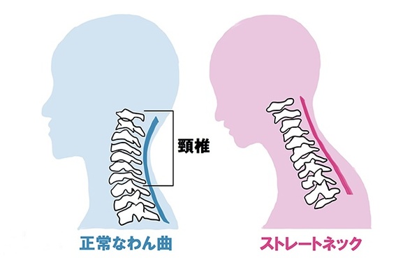 ★最近増えているストレートネック★