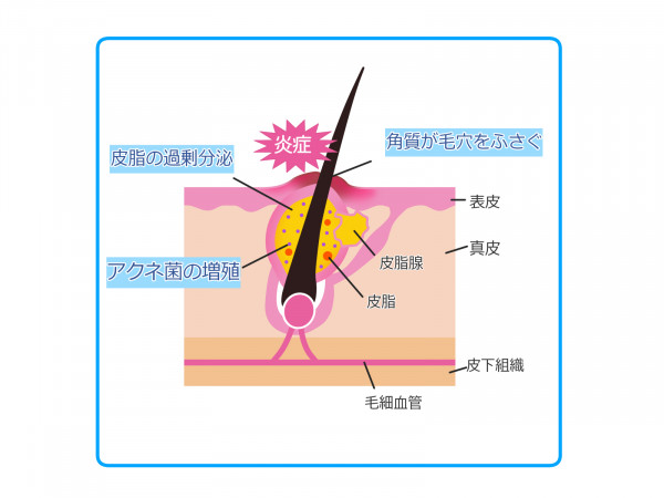 エムディ化粧品 マスク蒸れニキビに最強コンビ ミネラルマスク 薬用アクネクリーム 肌を育てるスキンケアショップ Aliaアリア 池下の隠れ家的フェイシャルサロンです