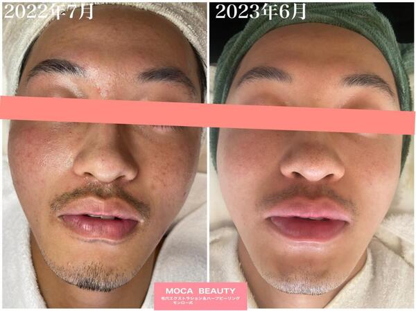 剥離なしハーブピーリングbefore&after｜MOCABEAUTY～毛穴エクストラ