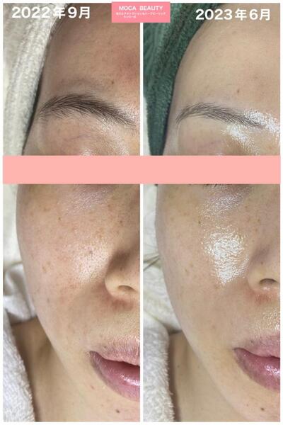 ハーブピーリングbefore&after｜MOCABEAUTY～毛穴エクストラクション